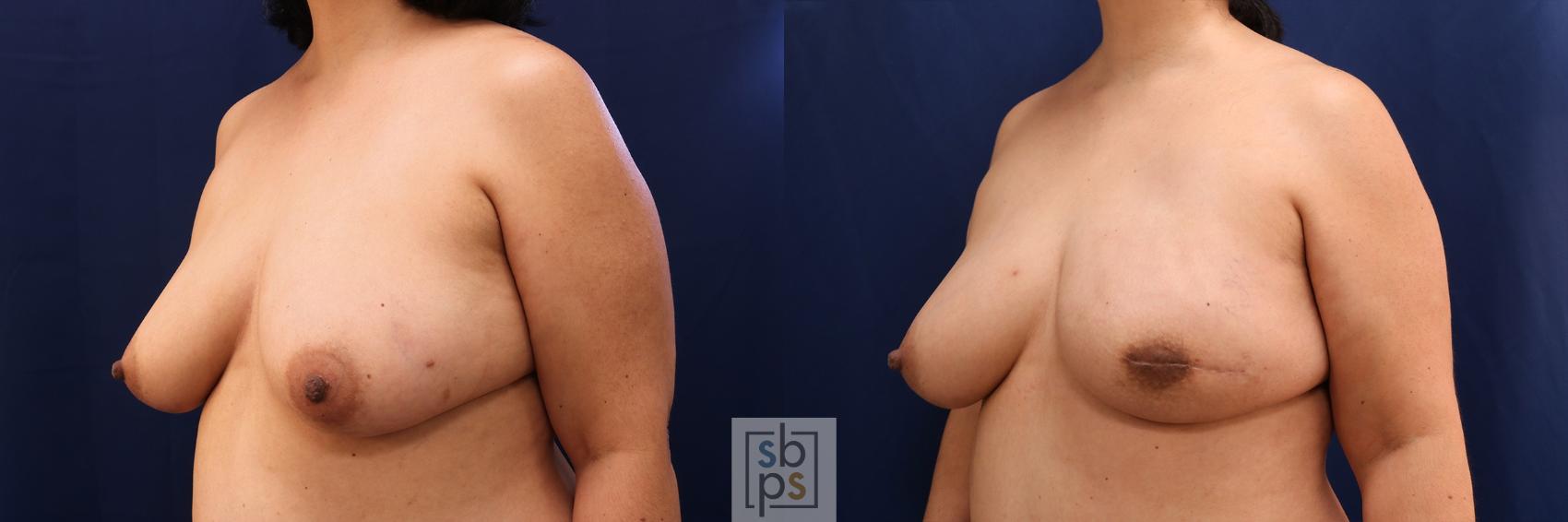 Before & After Breast Reconstruction Case 587 Left Oblique View in Torrance & Los Angeles, CA, CA