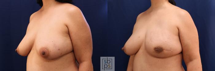 Before & After Breast Reconstruction Case 587 Left Oblique View in Torrance, CA