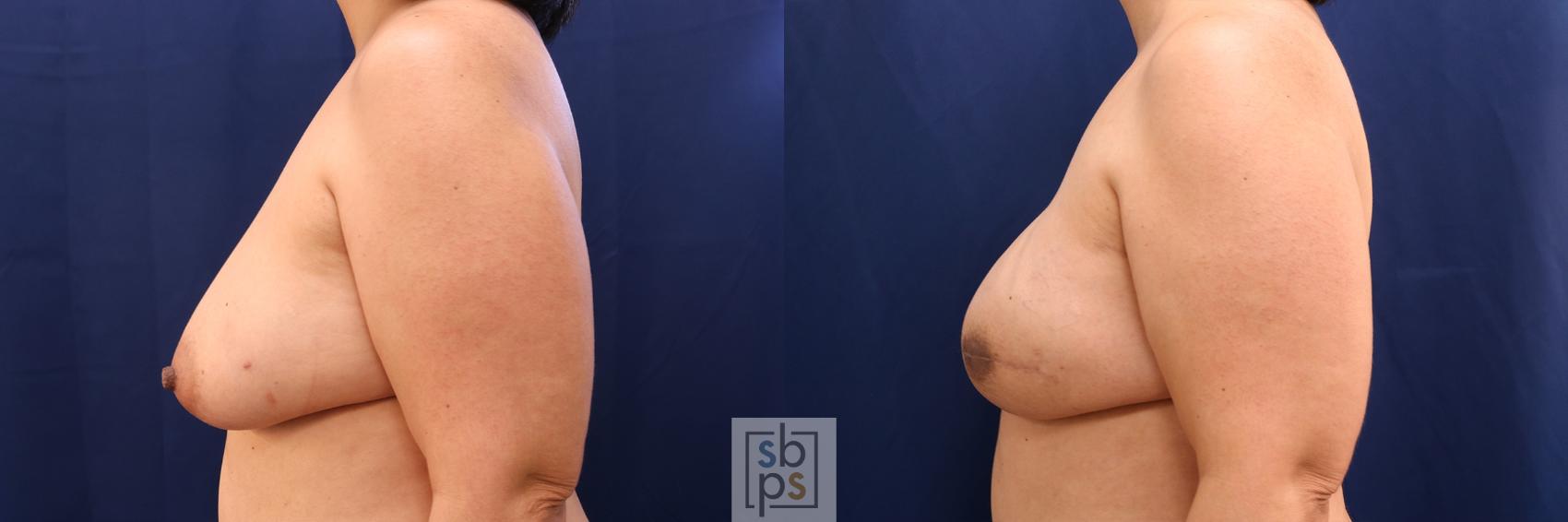 Before & After Breast Reconstruction Case 587 Left Side View in Torrance & Los Angeles, CA, CA