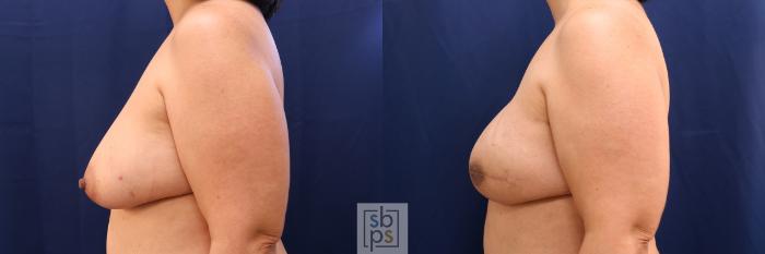Before & After Breast Reconstruction Case 587 Left Side View in Torrance, CA