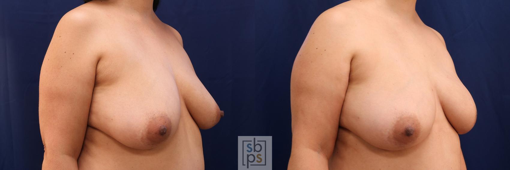 Before & After Breast Reconstruction Case 587 Right Oblique View in Torrance & Los Angeles, CA, CA