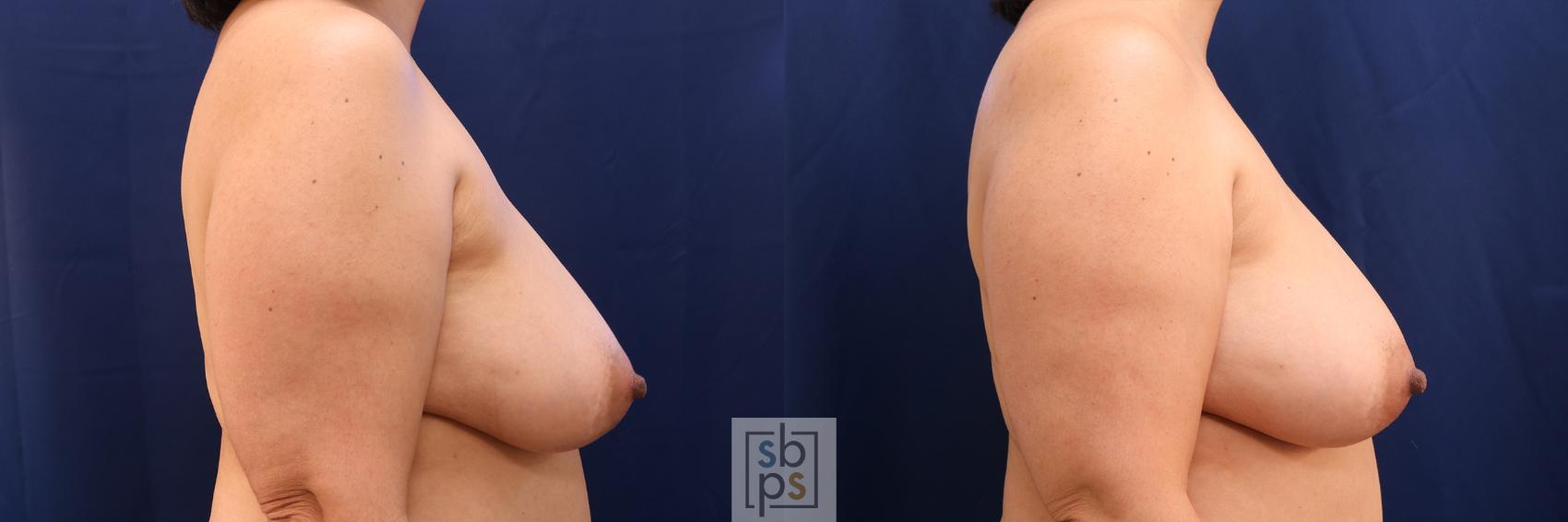 Before & After Breast Reconstruction Case 587 Right Side View in Torrance & Los Angeles, CA, CA