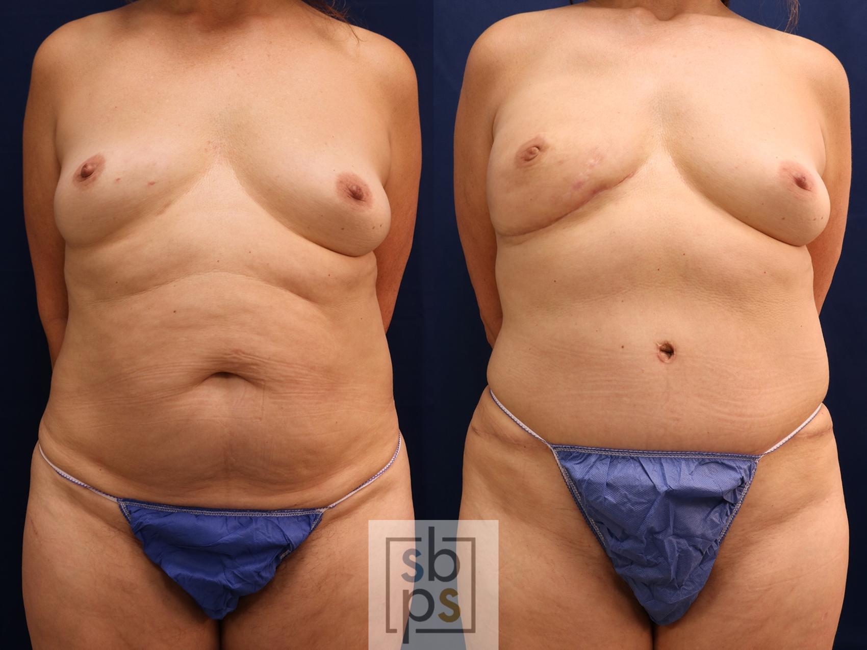 Before & After Breast Reconstruction Case 597 Front View in Torrance, CA