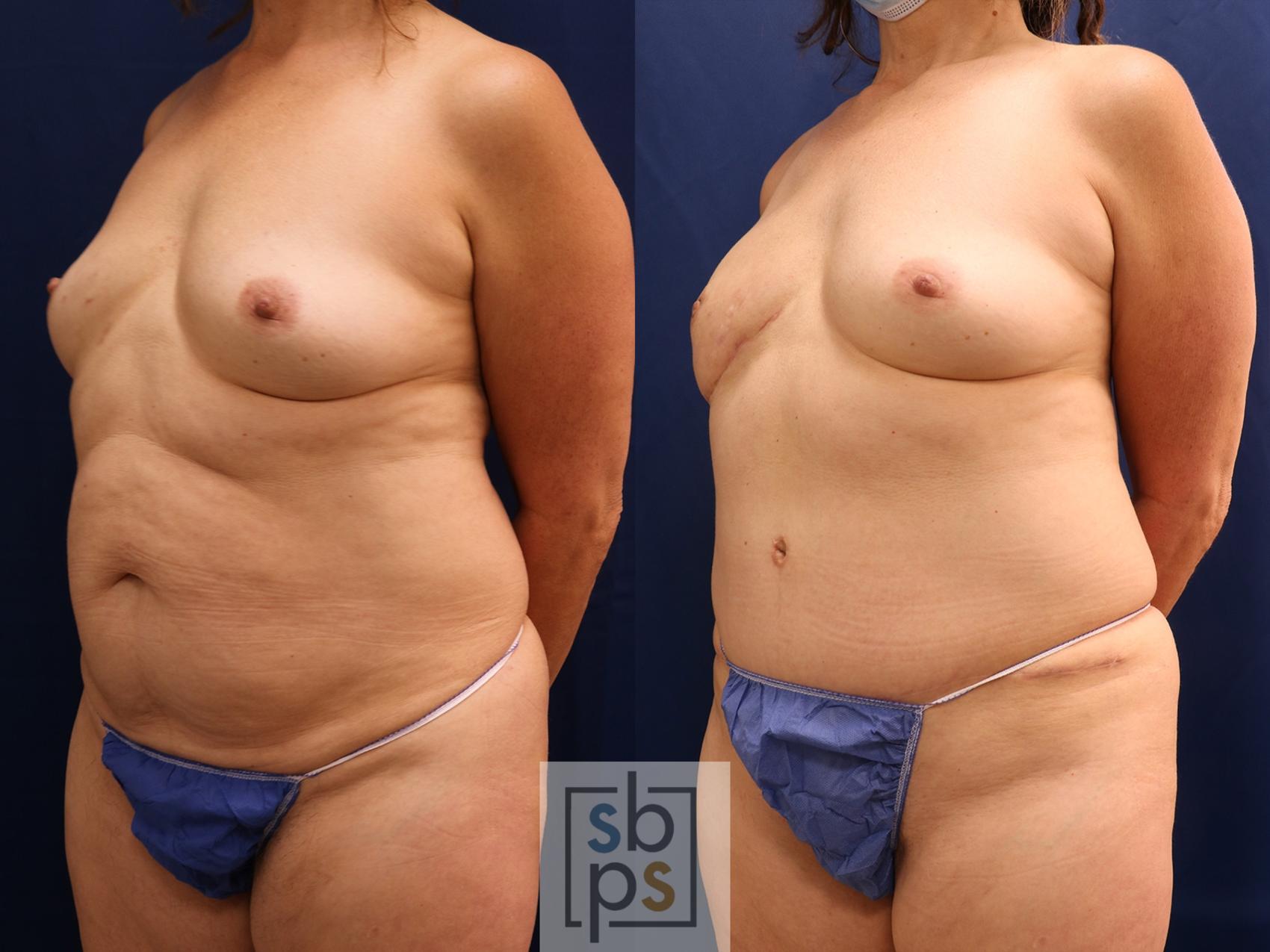 Before & After Breast Reconstruction Case 597 Left Oblique View in Torrance & Los Angeles, CA, CA