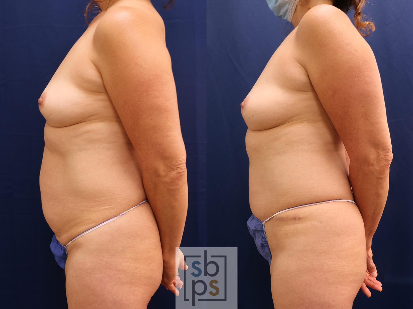 Before & After Breast Reconstruction Case 597 Left Side View in Torrance & Los Angeles, CA, CA