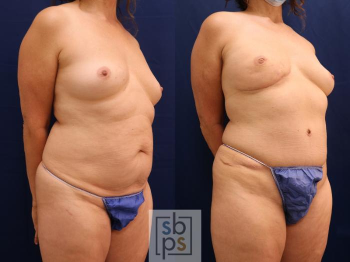 Before & After Breast Reconstruction Case 597 Right Oblique View in Torrance, CA