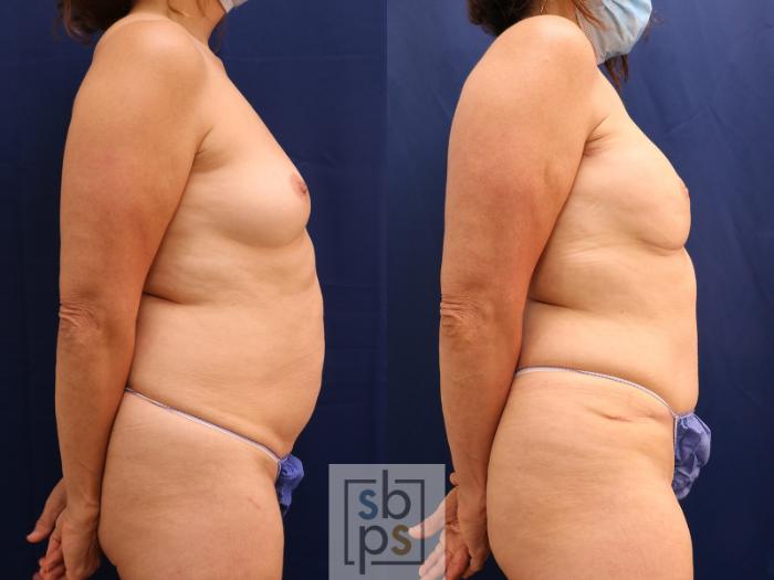 Before & After Breast Reconstruction Case 597 Right Side View in Torrance, CA