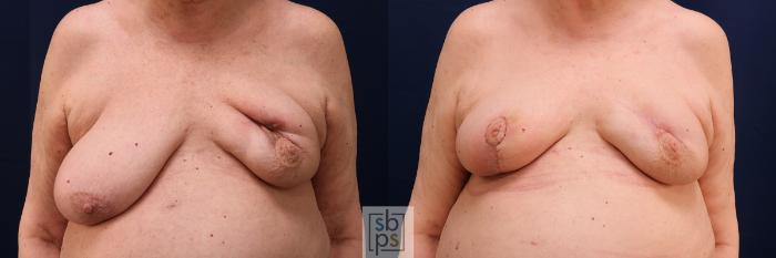 Before & After Breast Reconstruction Case 607 Front View in Torrance, CA
