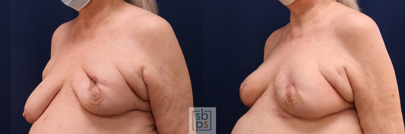 Before & After Breast Reconstruction Case 607 Left Oblique View in Torrance & Los Angeles, CA, CA