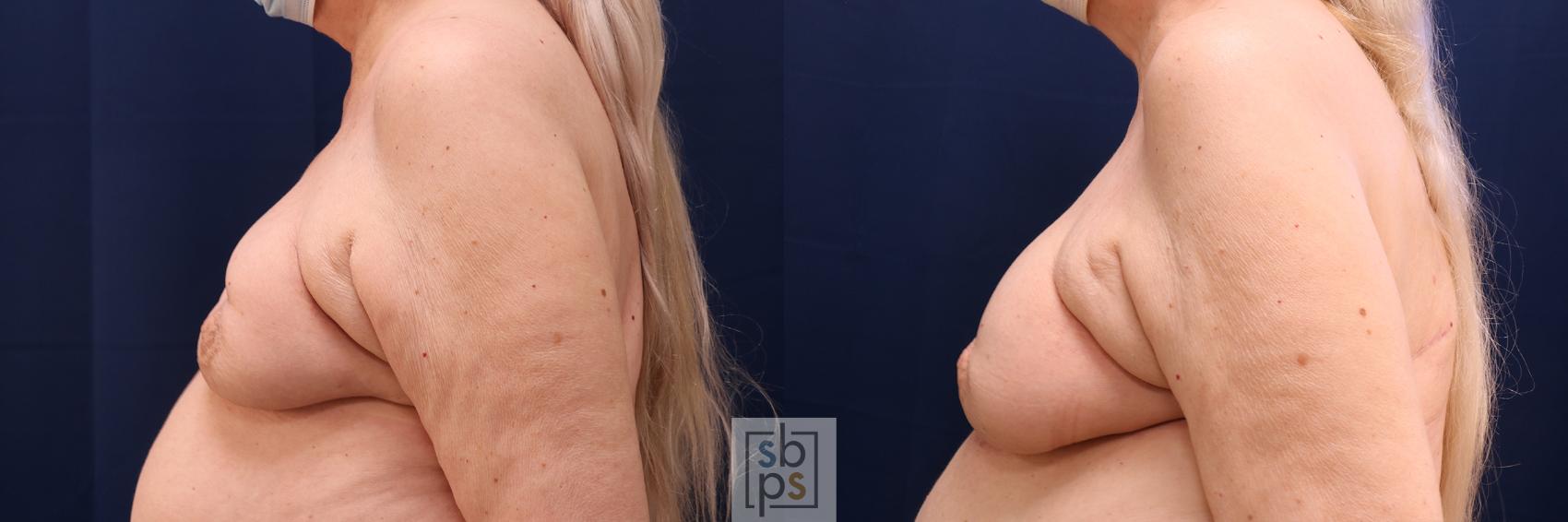 Before & After Breast Reconstruction Case 607 Left Side View in Torrance & Los Angeles, CA, CA