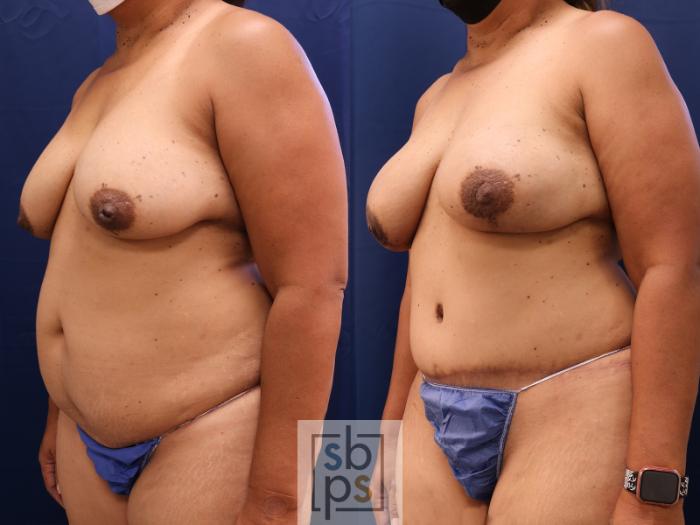 Before & After Breast Reconstruction Case 614 Left Oblique View in Torrance, CA