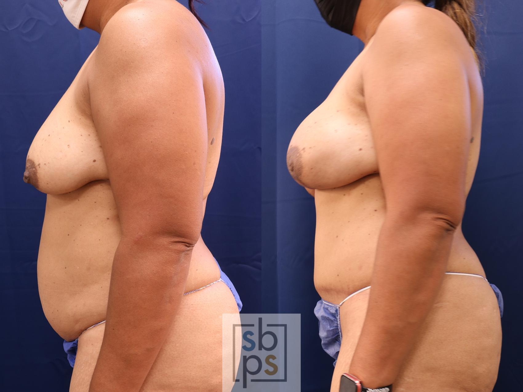Before & After Breast Reconstruction Case 614 Left Side View in Torrance, CA