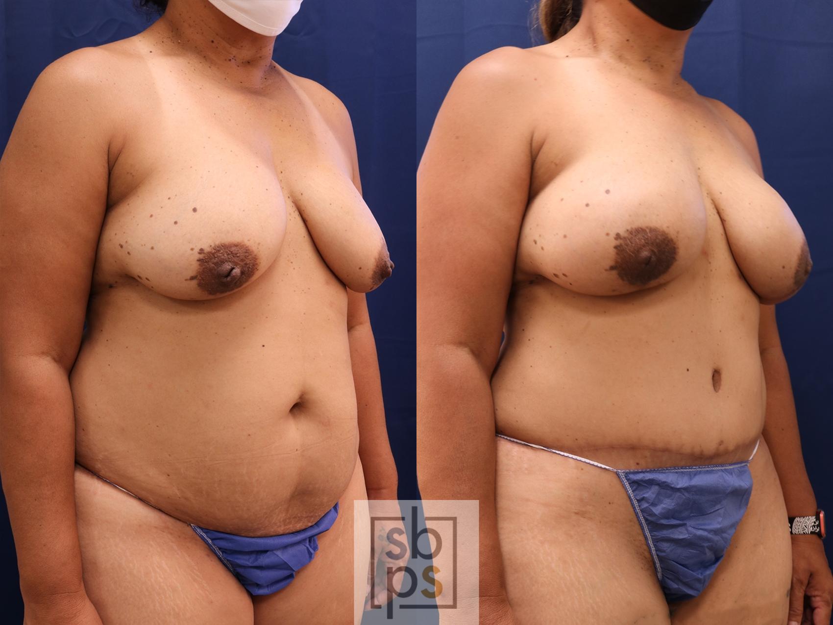 Before & After Breast Reconstruction Case 614 Right Oblique View in Torrance, CA