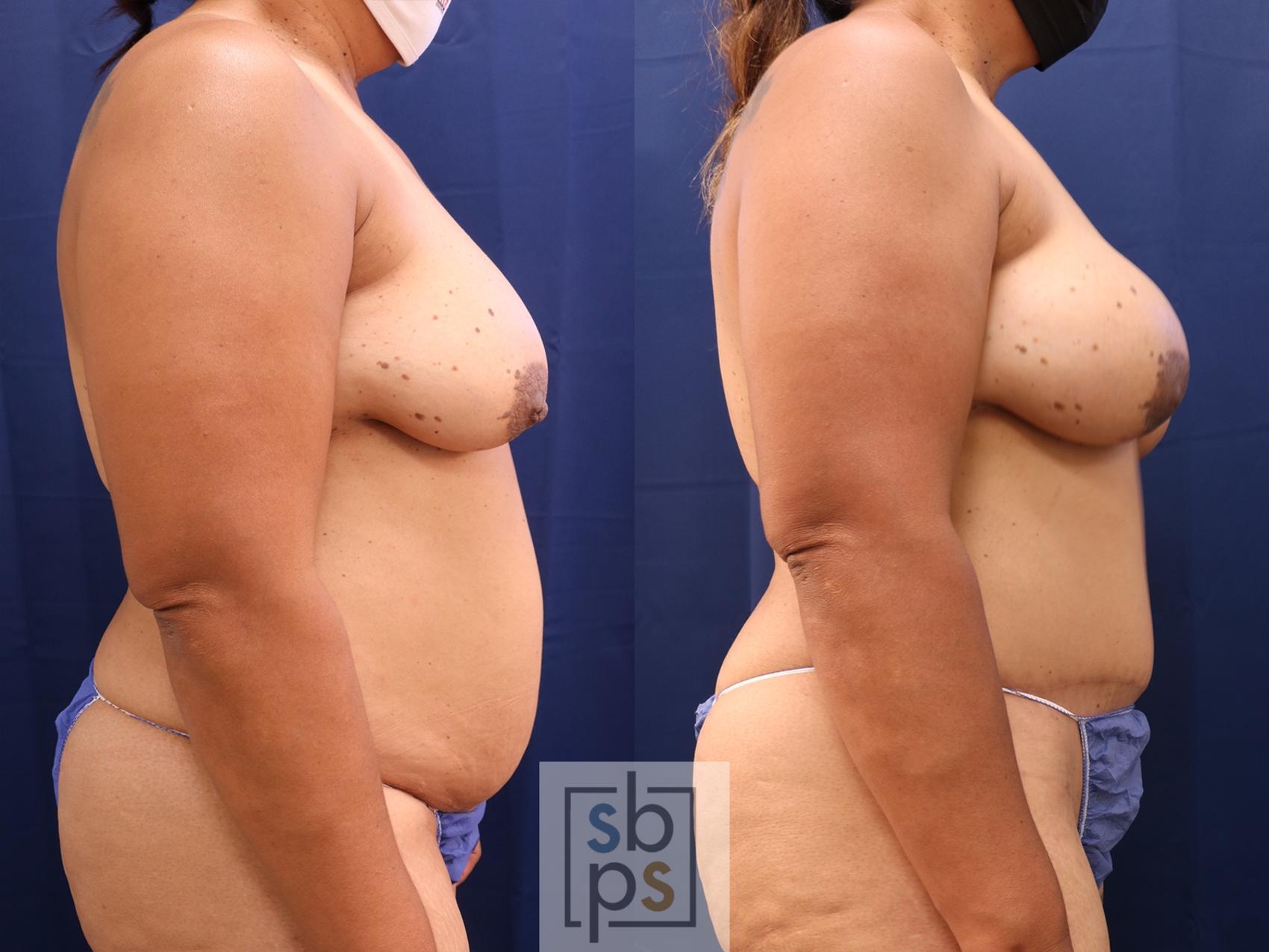 Before & After Breast Reconstruction Case 614 Right Side View in Torrance, CA