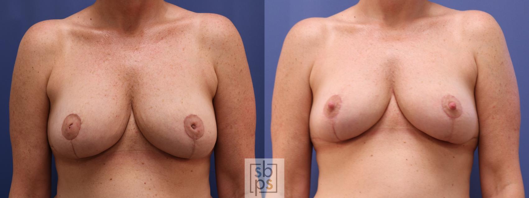 Before & After Nipple Reconstruction Case 622 Front - After Correction of Inverted Nipples View in Torrance & Los Angeles, CA, CA