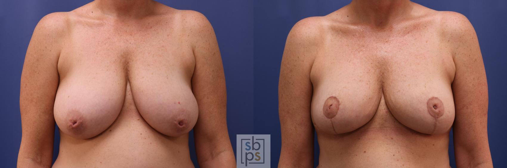 Before & After Breast Reconstruction Case 622 Front - Oncoplastic Reduction View in Torrance, CA