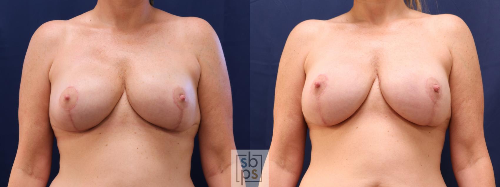 Before & After Nipple Reconstruction Case 622 Front - Tissue Expander to Implant Exchange View in Torrance & Los Angeles, CA, CA