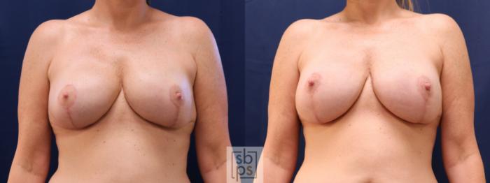 Before & After Breast Reconstruction Case 622 Front - Tissue Expander to Implant Exchange View in Torrance, CA