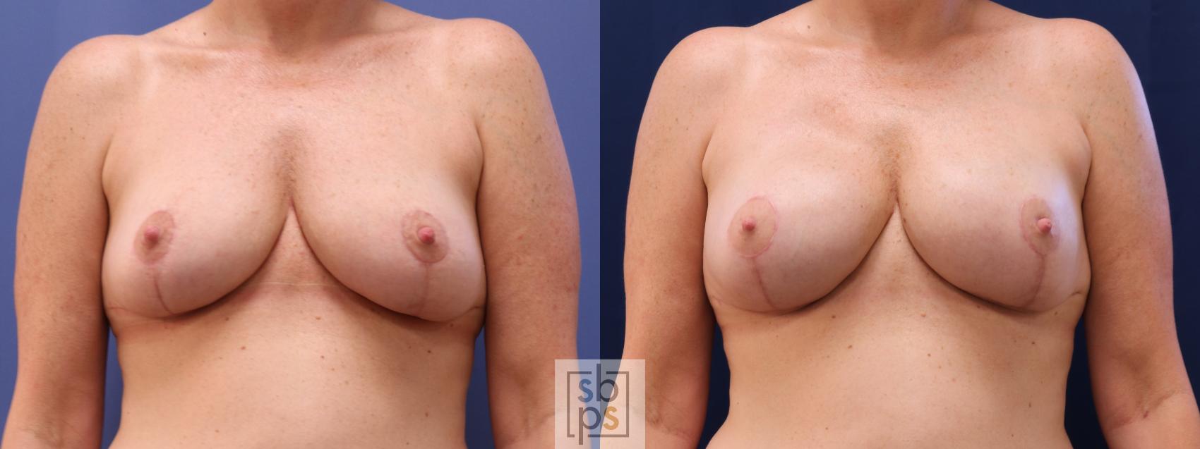 Before & After Nipple Reconstruction Case 622 Front - Tissue Expanders After Mastectomy View in Torrance & Los Angeles, CA, CA