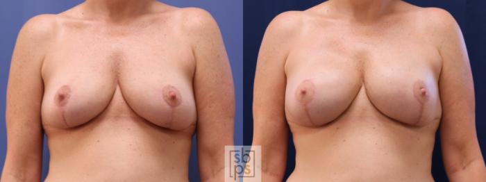 Before & After Breast Reconstruction Case 622 Front - Tissue Expanders After Mastectomy View in Torrance, CA