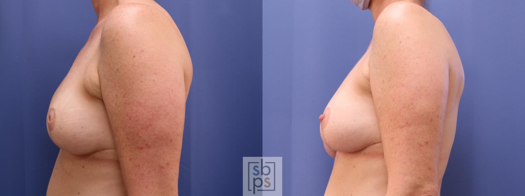 Before & After Nipple Reconstruction Case 622 Left - After Correction of Inverted Nipples View in Torrance & Los Angeles, CA, CA