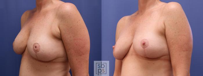 Before & After Breast Reconstruction Case 622 Left Oblique - After Correction of Inverted Nipples View in Torrance, CA