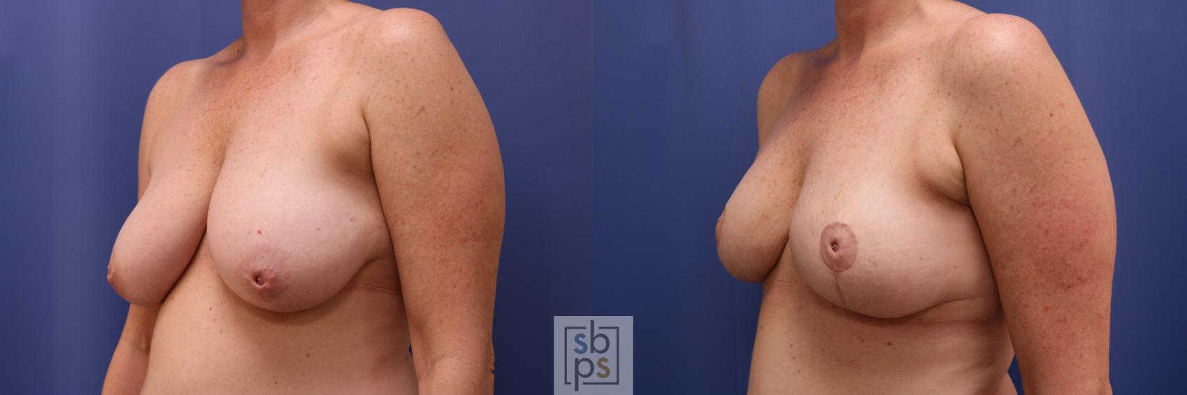 Before & After Nipple Reconstruction Case 622 Left Oblique - - Oncoplastic Reduction View in Torrance & Los Angeles, CA, CA