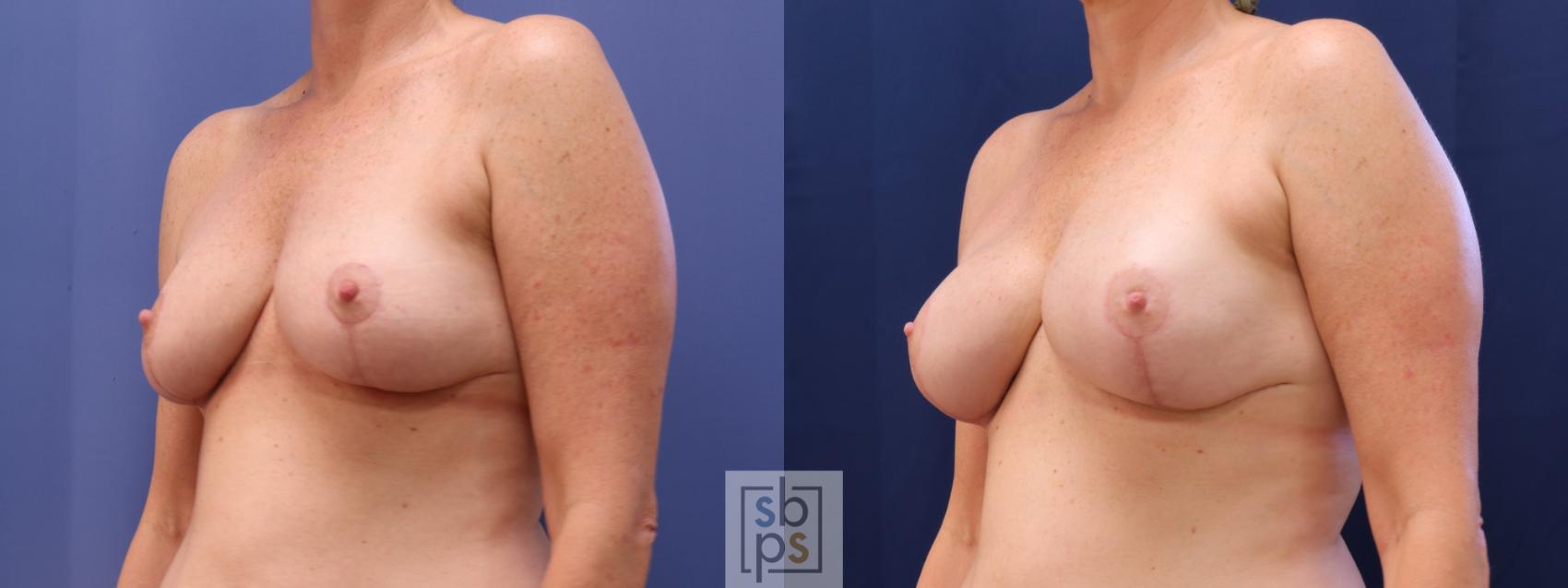 Before & After Nipple Reconstruction Case 622 Left Oblique - Tissue Expanders After Mastectomy View in Torrance & Los Angeles, CA, CA
