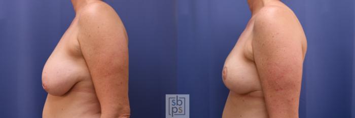 Before & After Breast Reconstruction Case 622 Left - Oncoplastic Reduction View in Torrance, CA