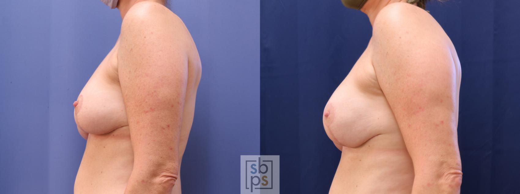 Before & After Nipple Reconstruction Case 622 Left - Tissue Expanders After Mastectomy View in Torrance & Los Angeles, CA, CA