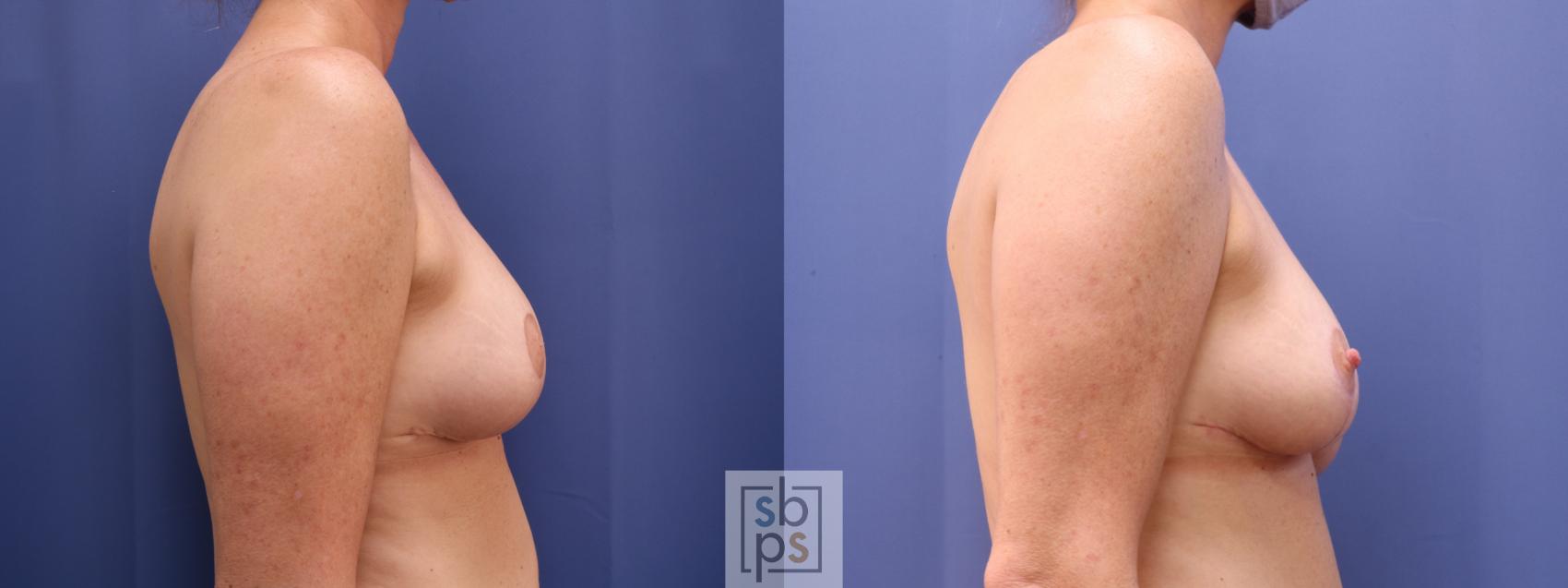 Before & After Nipple Reconstruction Case 622 Right - After Correction of Inverted Nipples View in Torrance & Los Angeles, CA, CA