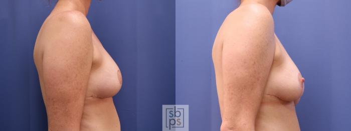 Before & After Breast Reconstruction Case 622 Right - After Correction of Inverted Nipples View in Torrance, CA