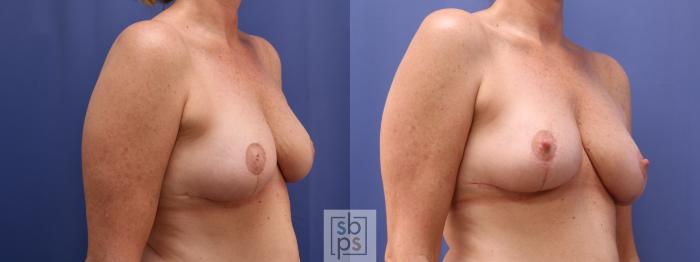 Before & After Breast Reconstruction Case 622 Right Oblique - After Correction of Inverted Nipples View in Torrance, CA