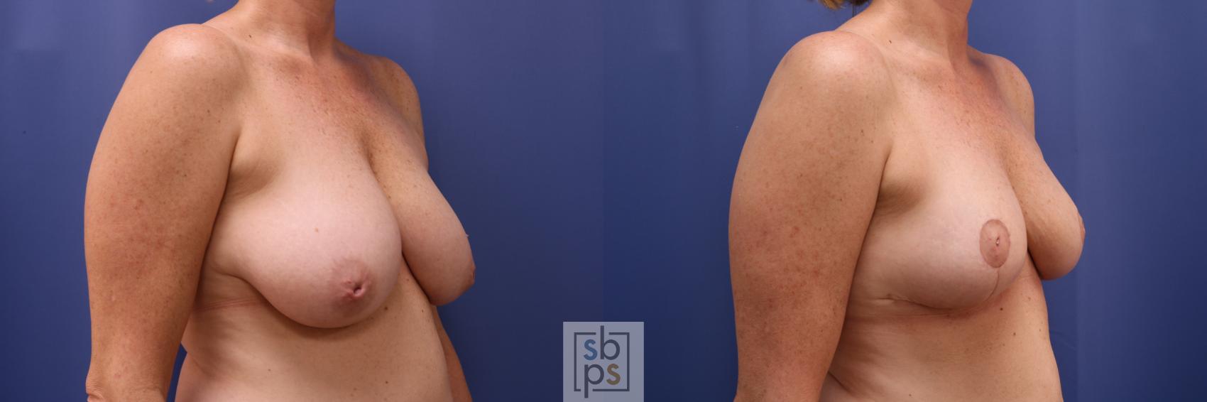 Before & After Nipple Reconstruction Case 622 Right Oblique - Oncoplastic Reduction View in Torrance & Los Angeles, CA, CA