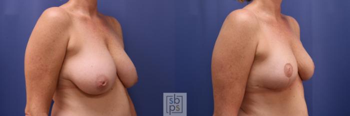 Before & After Breast Reconstruction Case 622 Right Oblique - Oncoplastic Reduction View in Torrance, CA