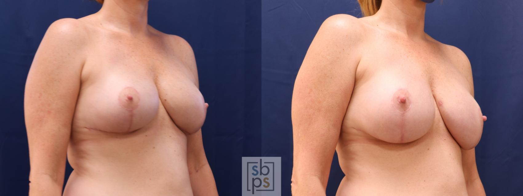 Before & After Nipple Reconstruction Case 622 Right Oblique - Tissue Expander to Implant Exchange View in Torrance & Los Angeles, CA, CA