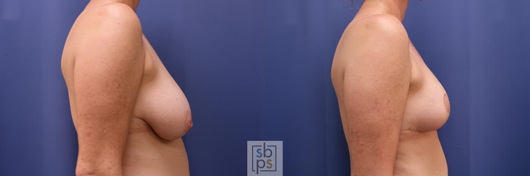 Before & After Nipple Reconstruction Case 622 Right - - Oncoplastic Reduction View in Torrance & Los Angeles, CA, CA