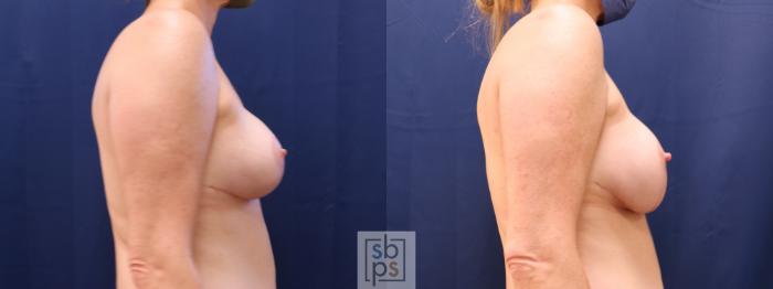 Before & After Breast Reconstruction Case 622 Right - Tissue Expander to Implant Exchange View in Torrance, CA