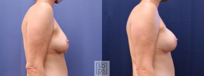 Before & After Breast Reconstruction Case 622 Right - Tissue Expanders After Mastectomy View in Torrance, CA