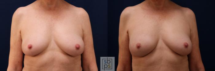 Before & After Breast Reconstruction Case 640 Front View in Torrance, CA