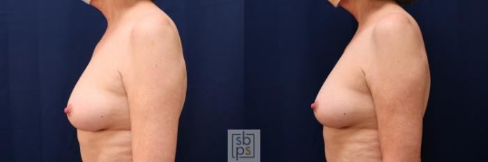 Before & After Breast Reconstruction Case 640 Left Side View in Torrance, CA