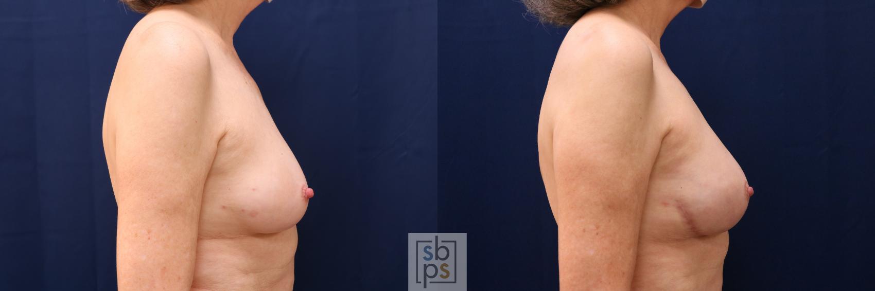 Before & After Breast Reconstruction Case 640 Right Side View in Torrance & Los Angeles, CA, CA