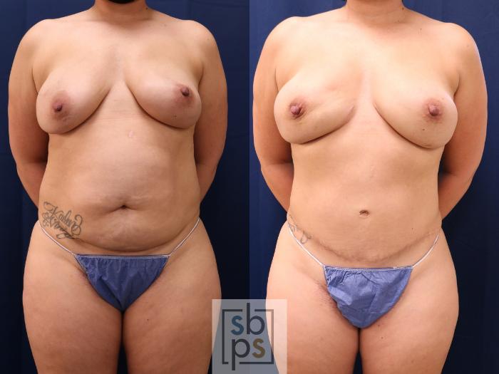 Before & After Breast Reconstruction Case 647 Front View in Torrance, CA