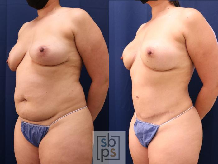Before & After Breast Reconstruction Case 647 Left Oblique View in Torrance, CA