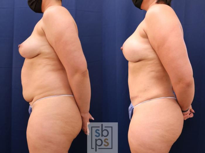 Before & After Breast Reconstruction Case 647 Left Side View in Torrance, CA