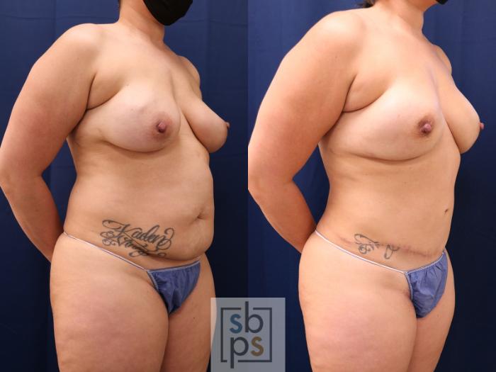 Before & After Breast Reconstruction Case 647 Right Oblique View in Torrance, CA