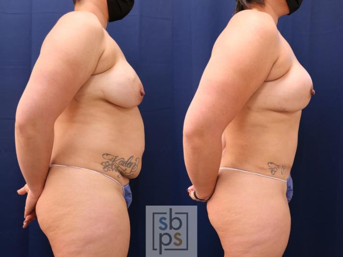 Before & After Breast Reconstruction Case 647 Right Side View in Torrance, CA