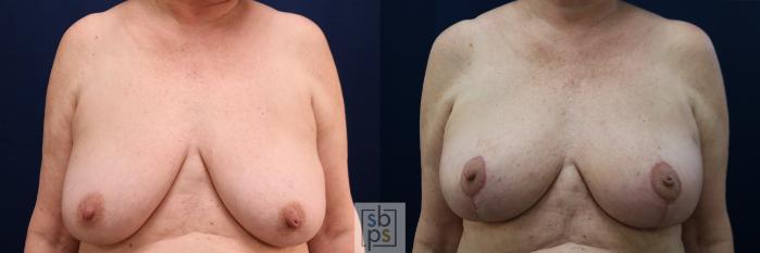 Before & After Breast Reconstruction Case 654 Front View in Torrance, CA