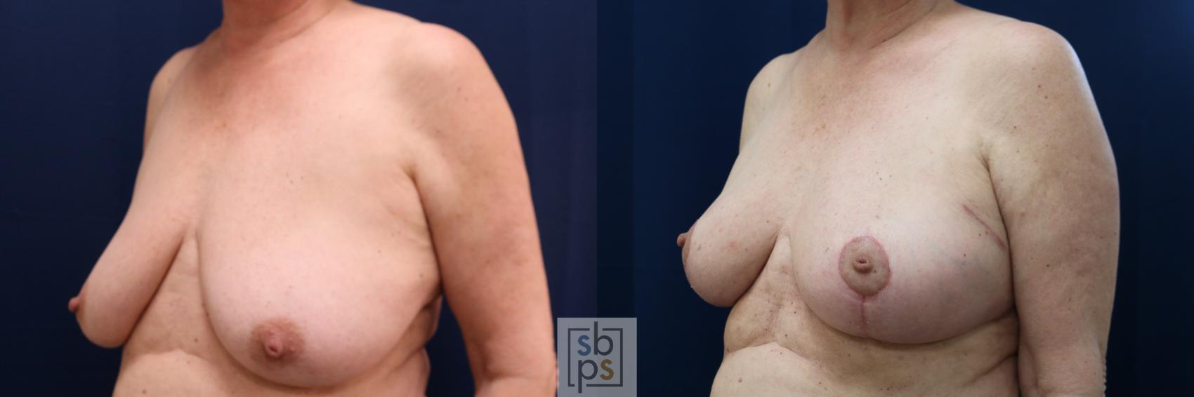 Before & After Breast Reconstruction Case 654 Left Oblique View in Torrance & Los Angeles, CA, CA