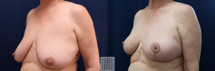 Before & After Breast Reconstruction Case 654 Left Oblique View in Torrance, CA